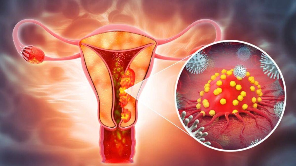 Cáncer de ovario mata a 89 mujeres al año en RD por diagnósticos tardíos