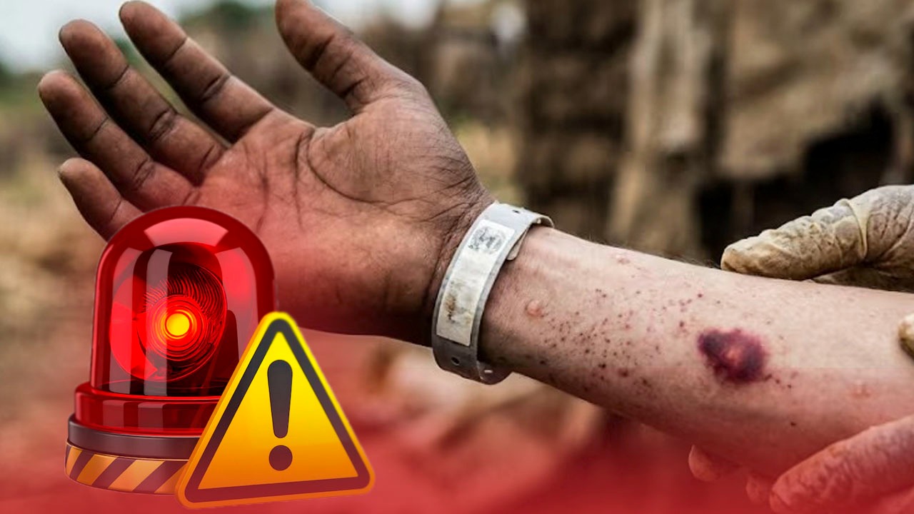 Brote de ébola en África alerta al mundo